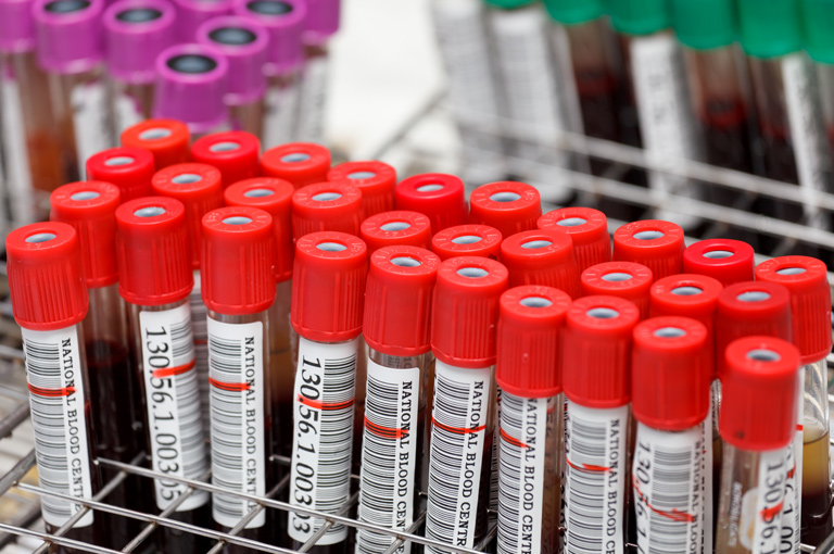 Tekuća biopsija mogla bi otkriti rak gušterače u najranijoj fazi