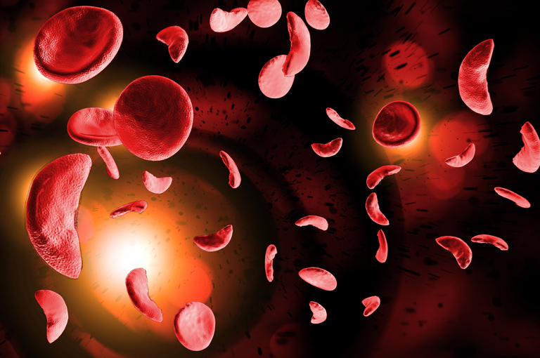Terapija hidroksiurejom može ublažiti ili preokrenuti srčane komplikacije u pacijenata sa anemijom srpastih stanica
