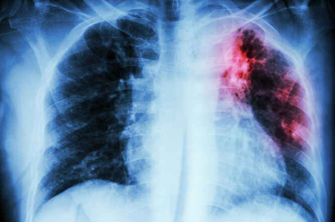 Tuberkuloza povezana s povećanim rizikom od raka