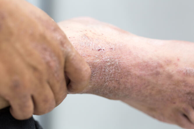 U oko 10 posto ljudi tijekom života dolazi do razvoja atopijskog dermatitisa