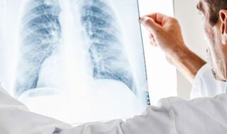 Uzorci snimki pluća predviđaju težinu sarkoidoze i problema s disanjem