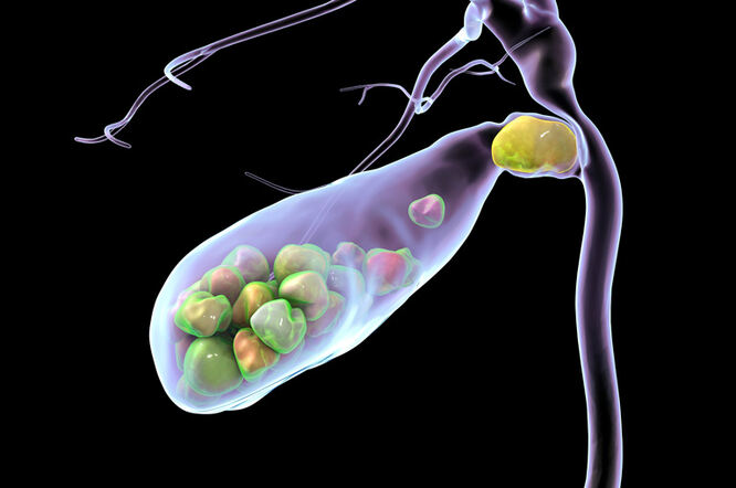 Veći unos šećera povećava rizik od žučnih kamenaca kod odraslih