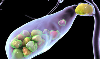 Veći unos šećera povećava rizik od žučnih kamenaca kod odraslih