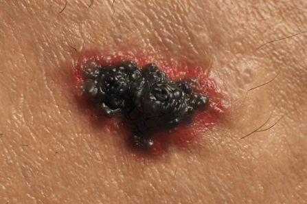 Većina melanoma ipak nije maligna transformacija madeža