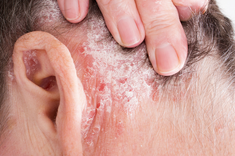 Većina pacijenata s psorijazom može sigurno smanjiti dozu bioloških lijekova