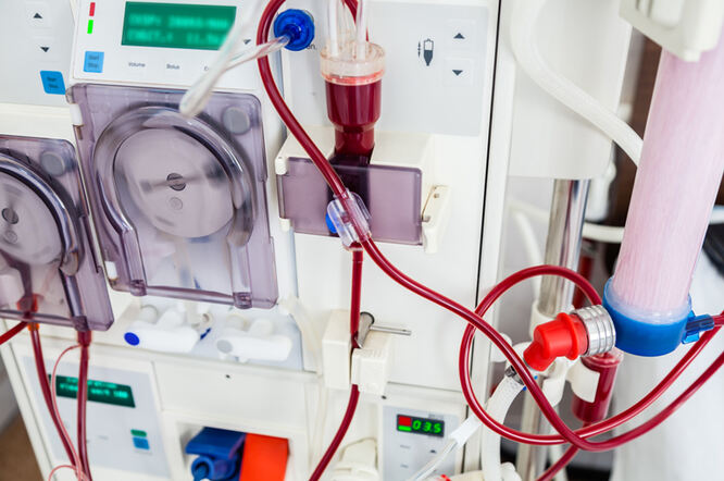Visoke doze intravenskog željeza smanjuju rizik od srčanog udara kod pacijenata na hemodijalizi