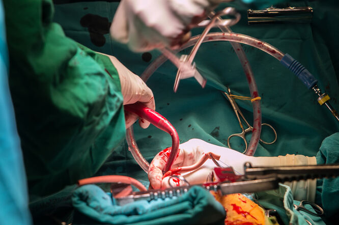 Žene i dalje pod većim rizikom od neželjenih ishoda nakon operacije premoštenja koronarnih arterija 