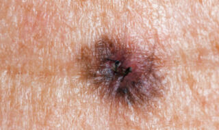 Živčana vlakna unutar melanoma usporavaju rast tumora